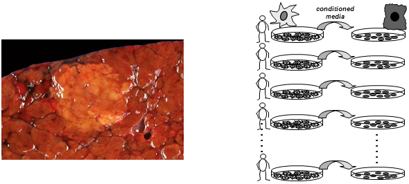 Hepatocellular carcinoma