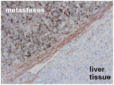 Hepatic metastasis